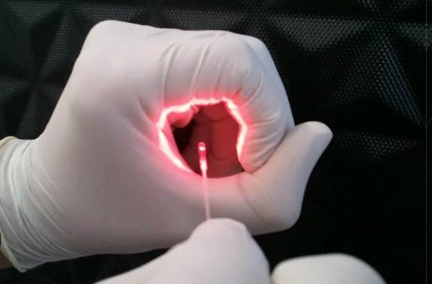 Cirurgia a Laser